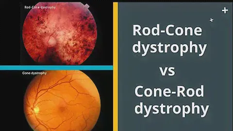 Rod Cone dystrophy VS Cone Rod dystrophy