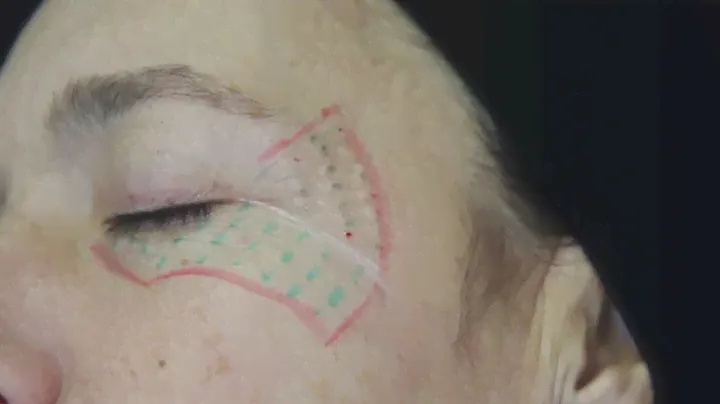 Jalupro + Botulinum Toxin Forhead and Periocular Wrinkles
